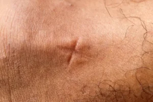 X on mosquito bite, a temporary way to stop itching